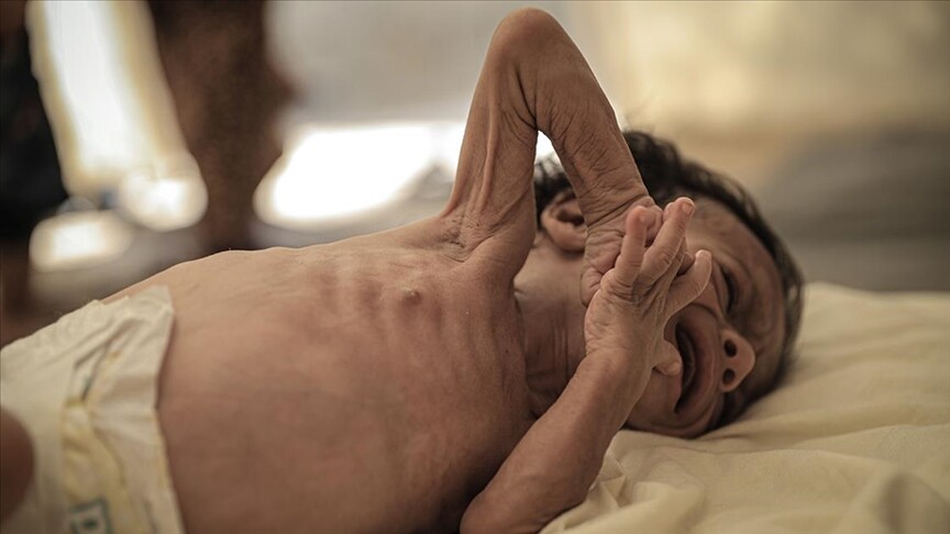 Bangladeş'te 15 Mart'tan bu yana kızamık belirtileri gösterdikten sonra ölen çocuk sayısı 409'a çıktı